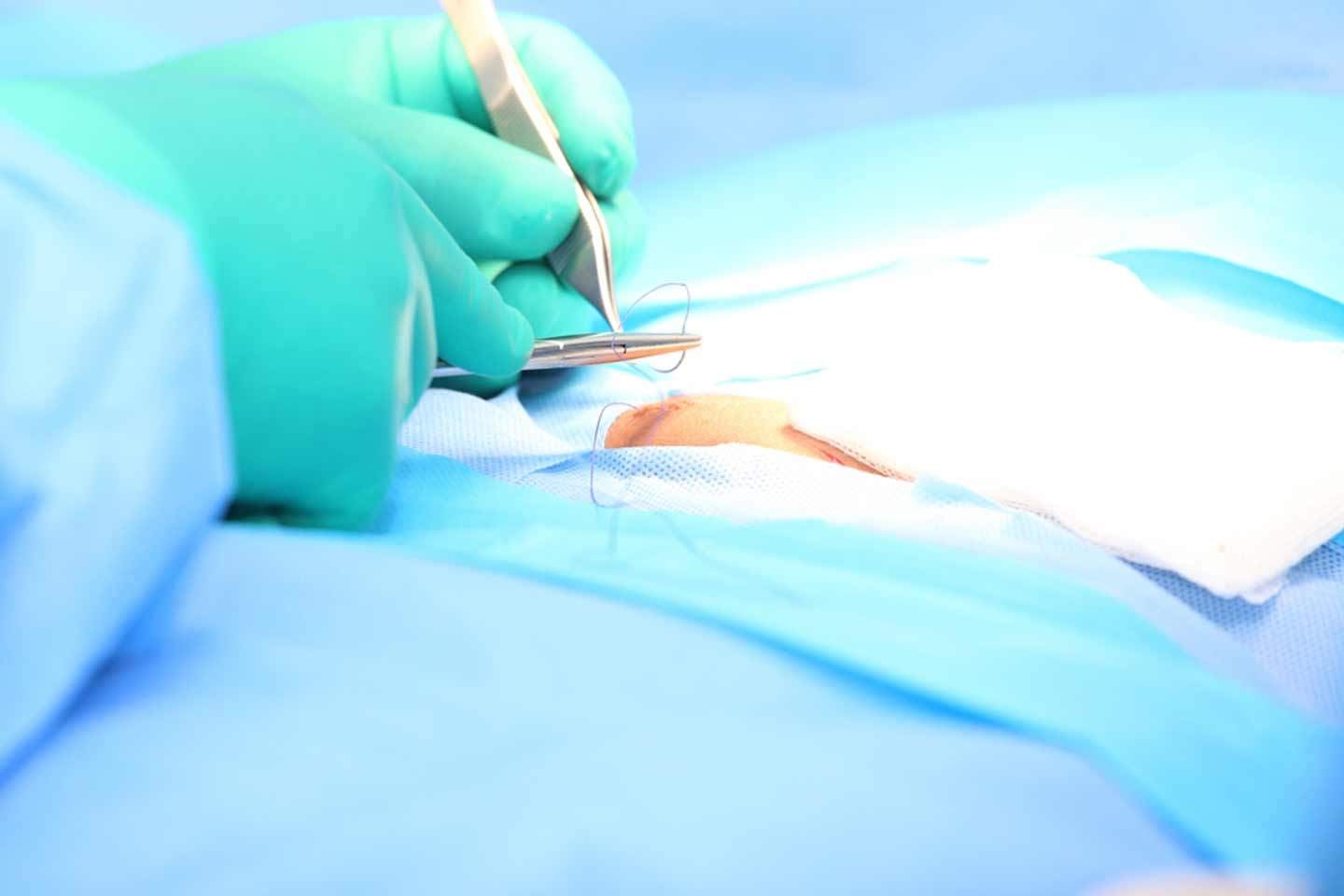 cerrahi ameliyat ipligi sutur nedir sutur nasil atilir 1